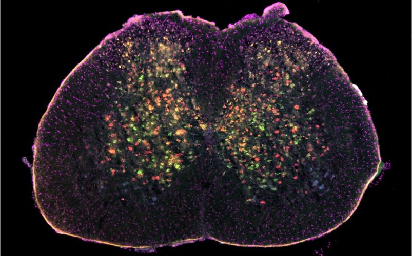 AI supports breakthrough ALS research